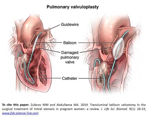 JLSB-1109-balloon_valvotomy-low