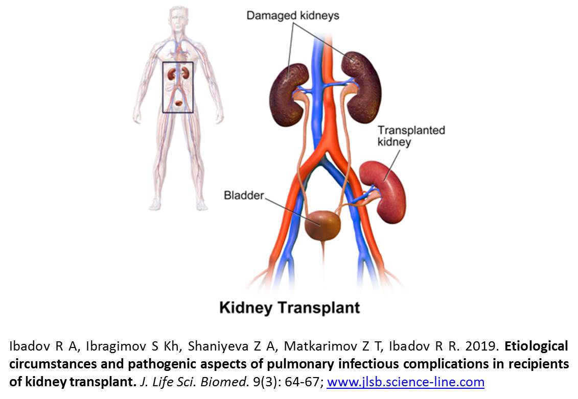 JLSB-24March-2019-Kidney_Transplant