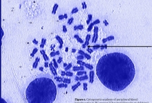 JLSB-03Nov-2017-peripheral_blood_lymphocytes_in_breast_cancer_women