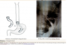 endoscopic_therapy_in_cardioesophageal_cancer