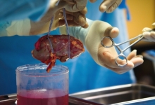 living-related_kidney_transplantation