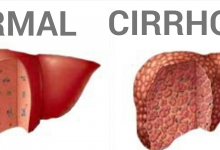 JLSB-1105_-_cirrhosis