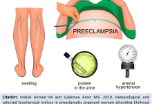 preeclamptic_pregnant_women_OJAFR